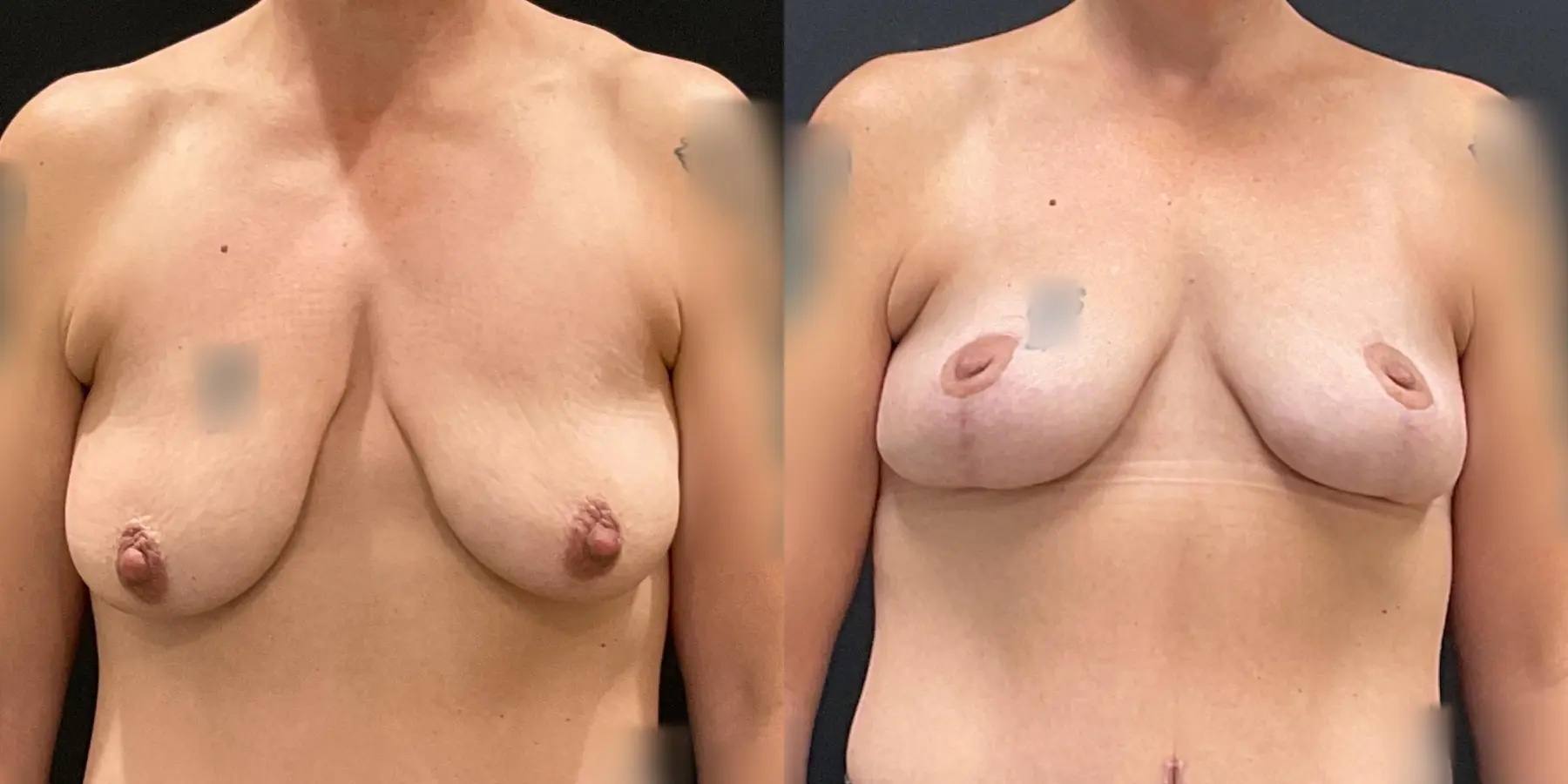 Breast Lift: Patient 8 - Before and After  