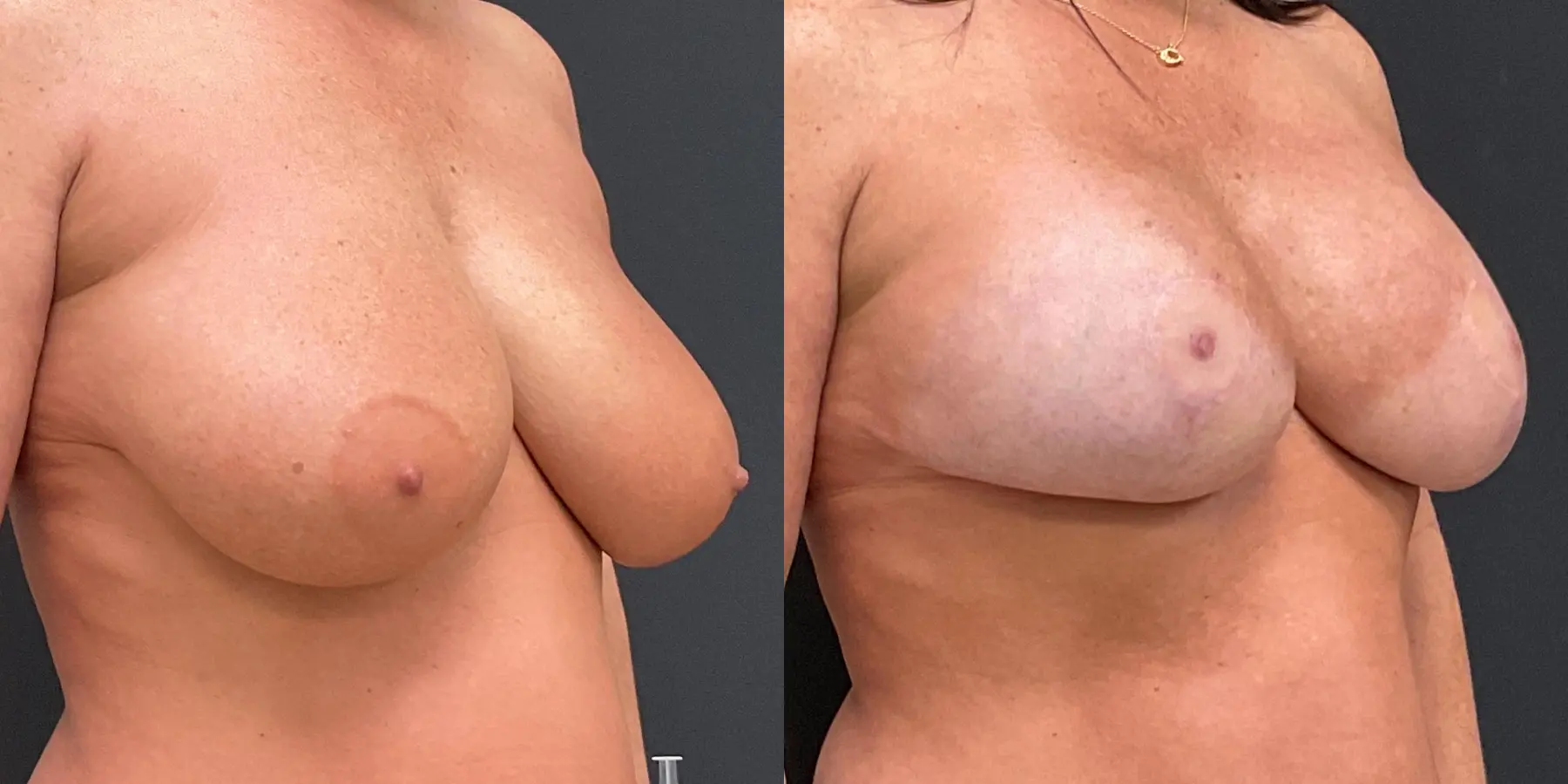 Breast Lift: Patient 6 - Before and After 3