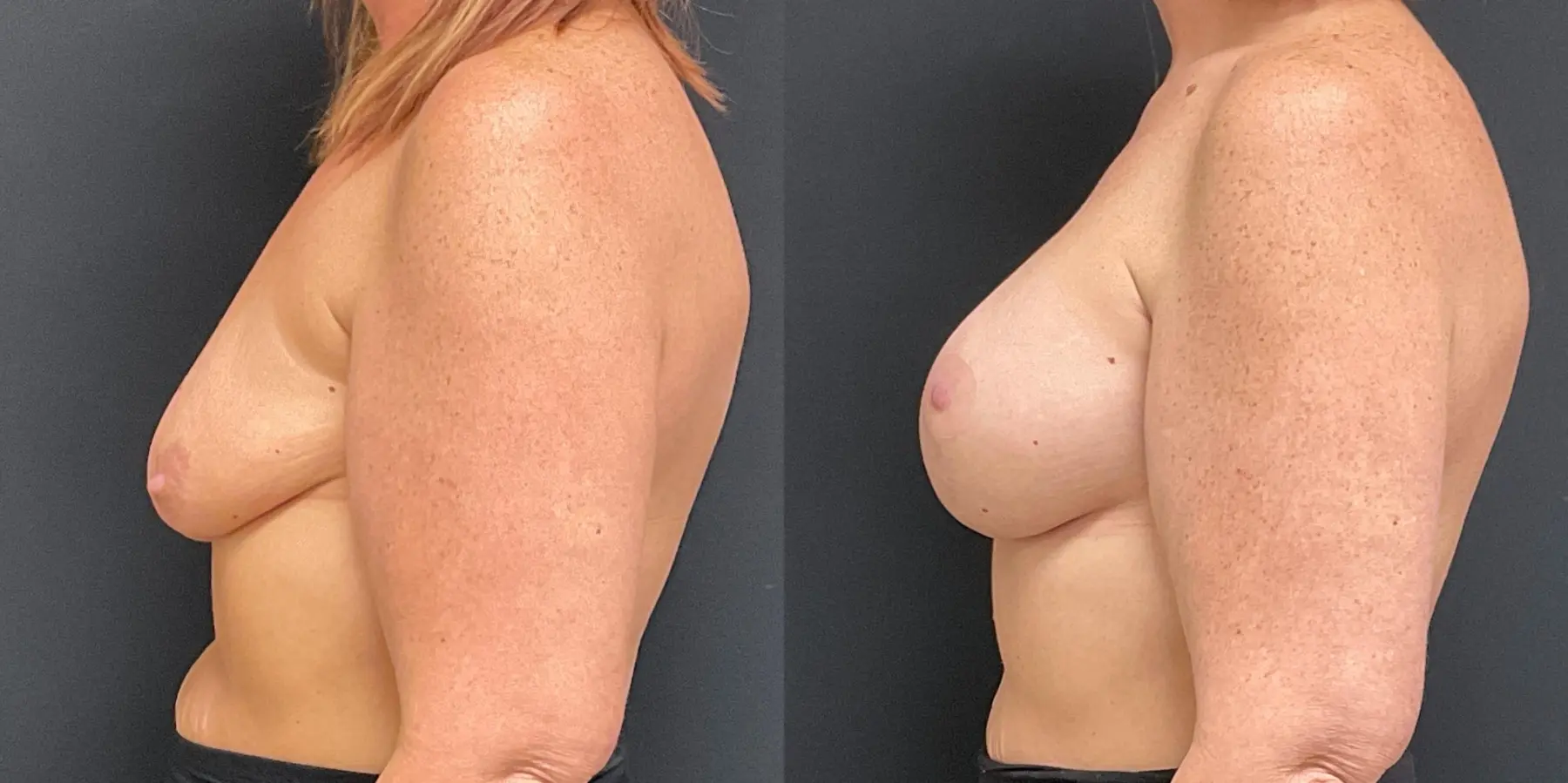 Breast Lift: Patient 13 - Before and After 4