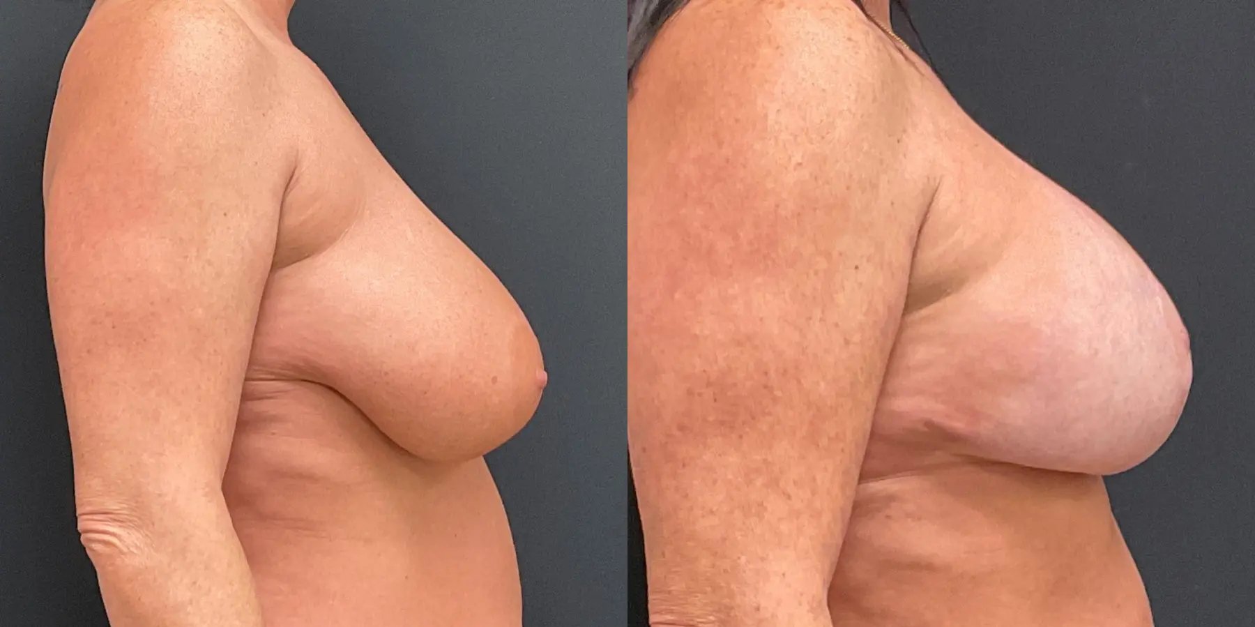 Breast Lift: Patient 6 - Before and After 5