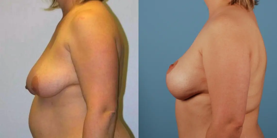 Breast Lift: Patient 7 - Before and After 3