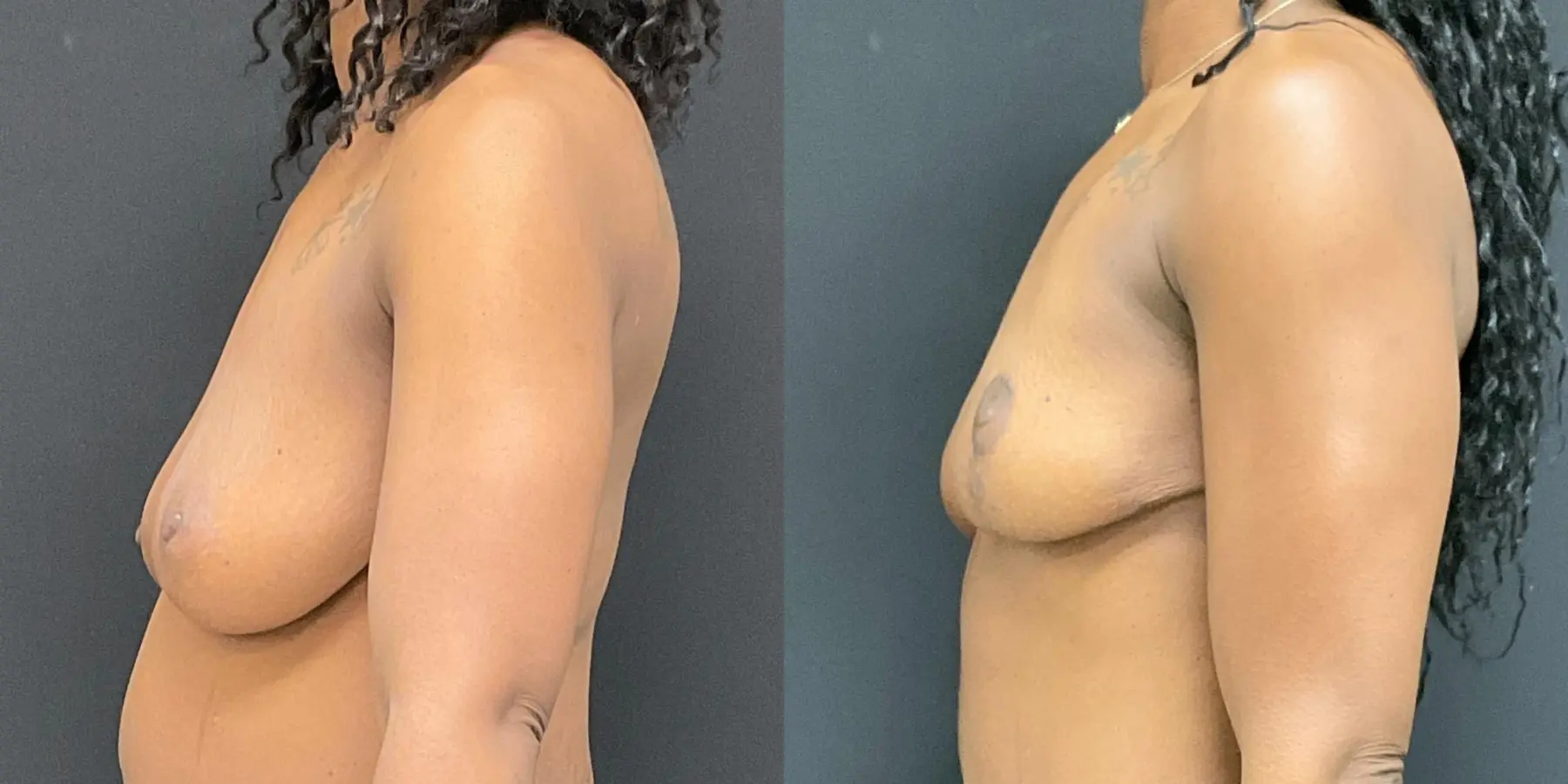 Breast Lift: Patient 4 - Before and After 4