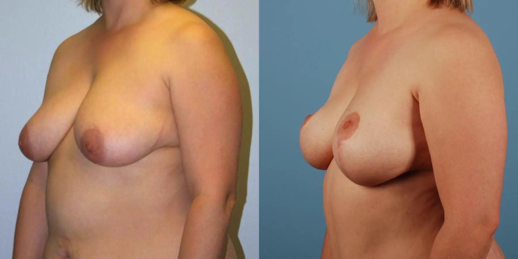 Breast Lift: Patient 7 - Before and After 2