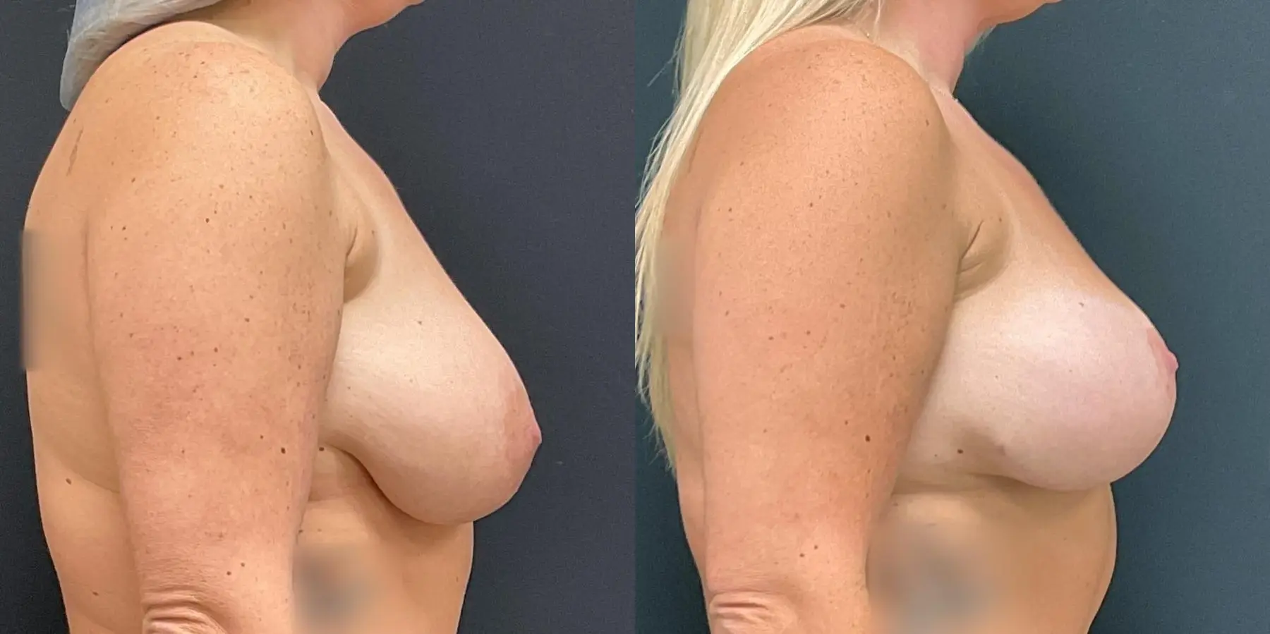 Breast Lift: Patient 9 - Before and After 5