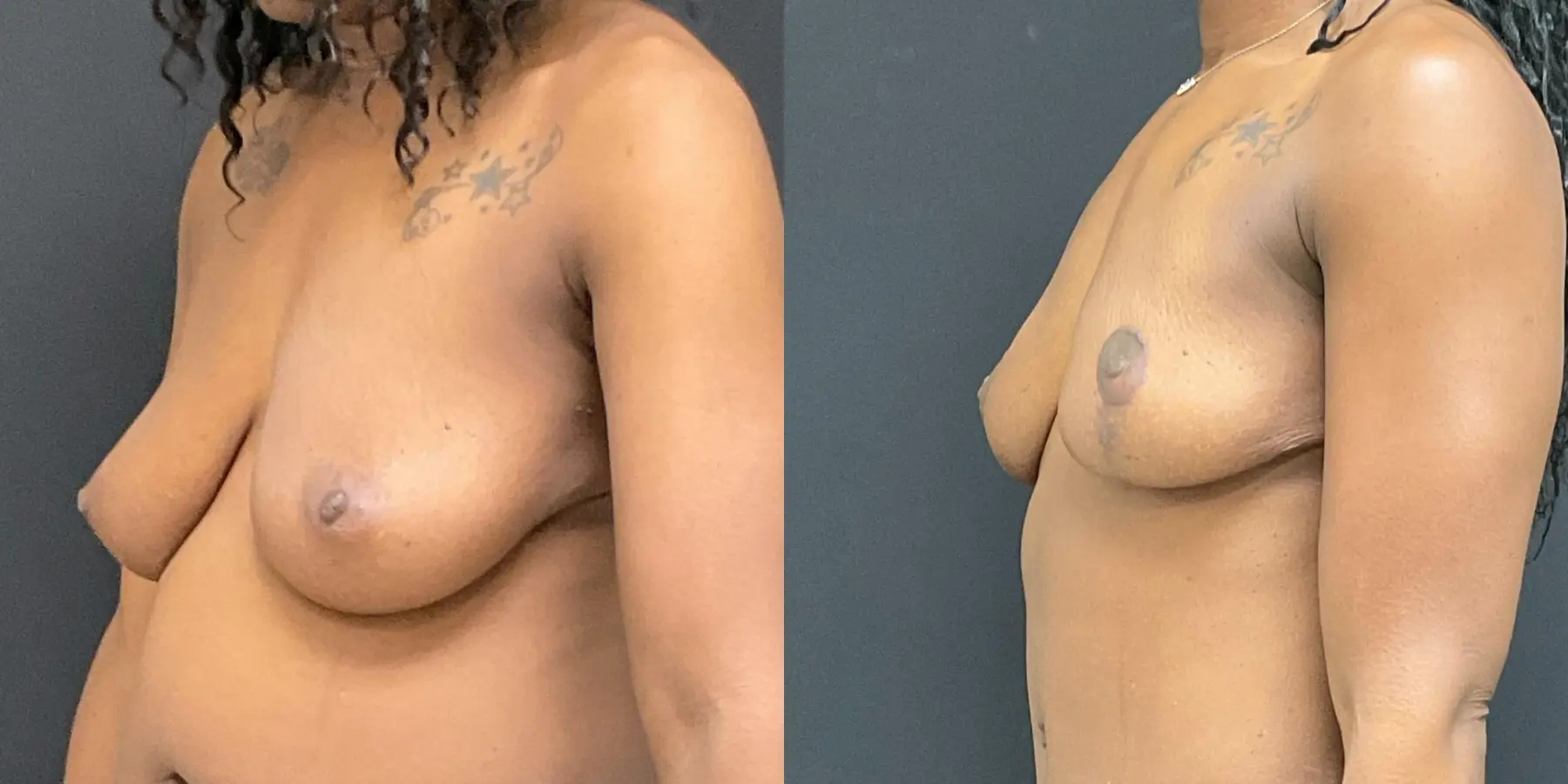Breast Lift: Patient 4 - Before and After 2