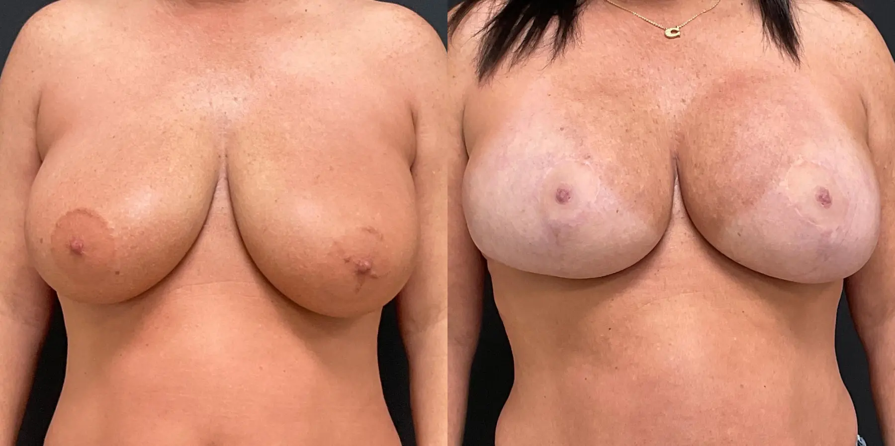 Breast Lift: Patient 12 - Before and After  
