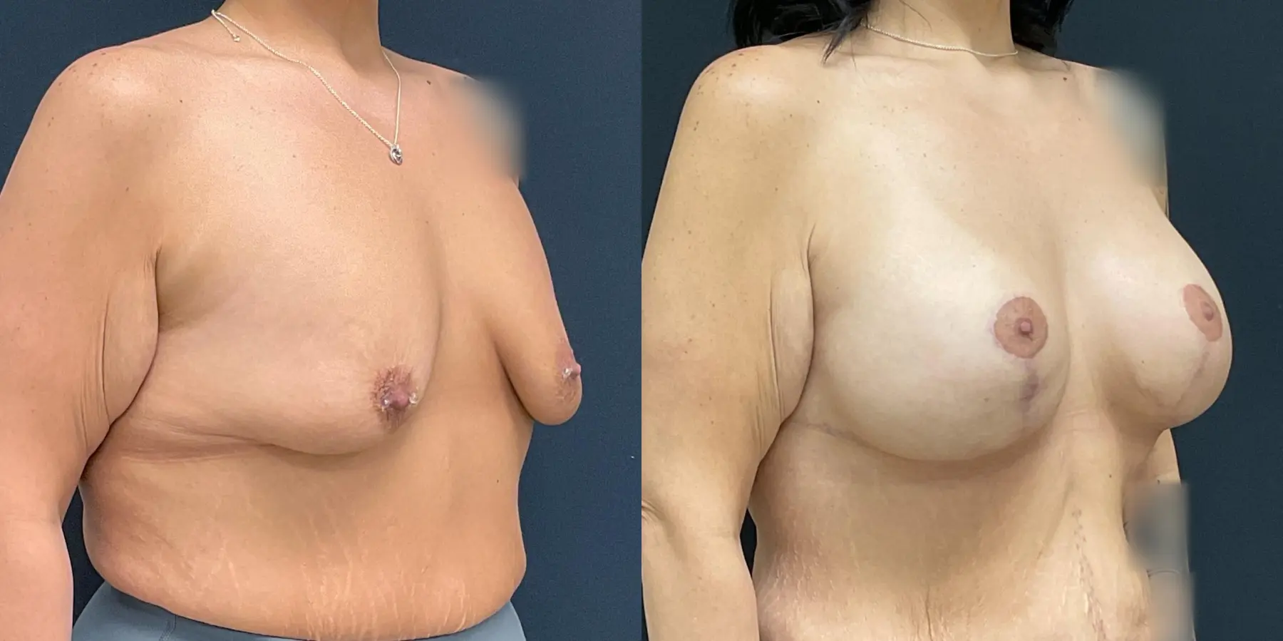 Breast Lift: Patient 8 - Before and After 3