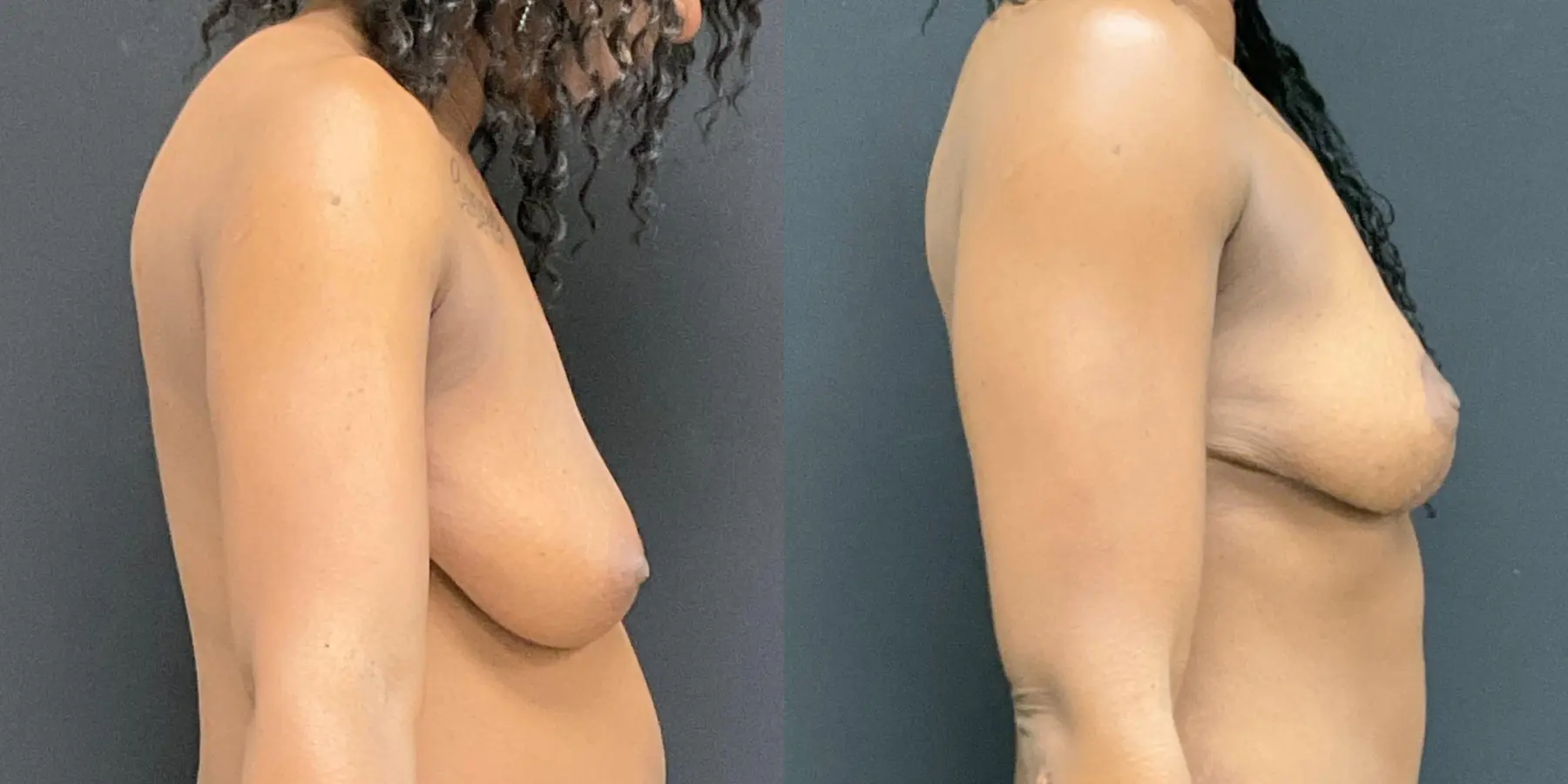 Breast Lift: Patient 4 - Before and After 5