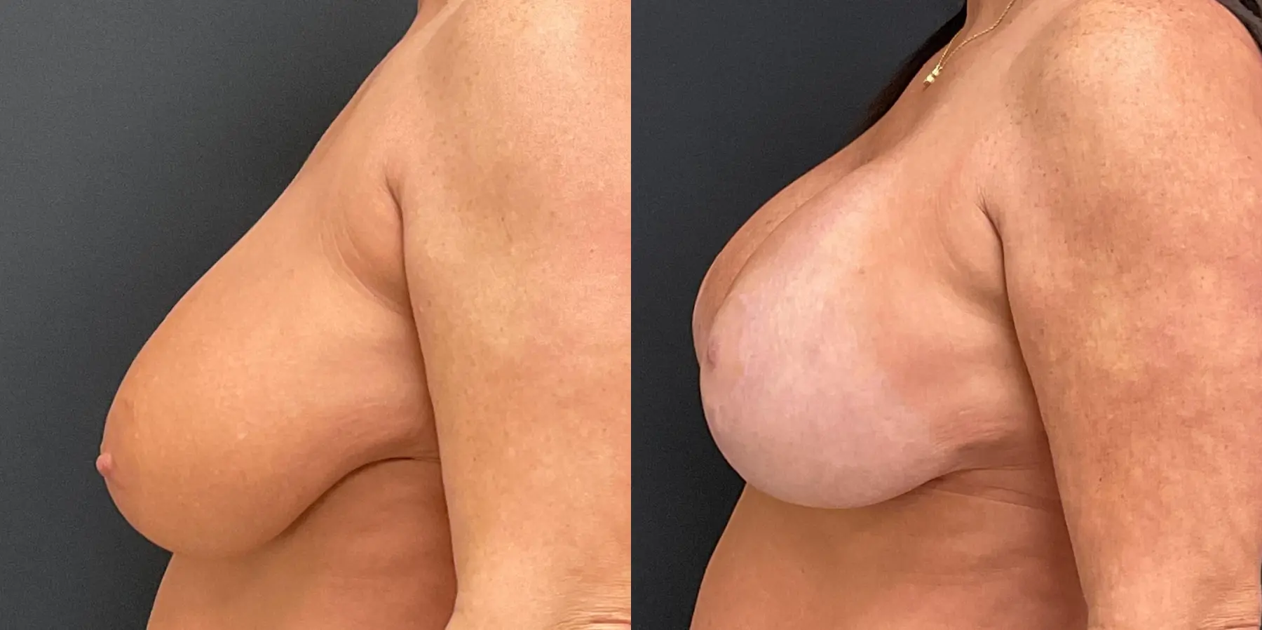 Breast Lift: Patient 6 - Before and After 4