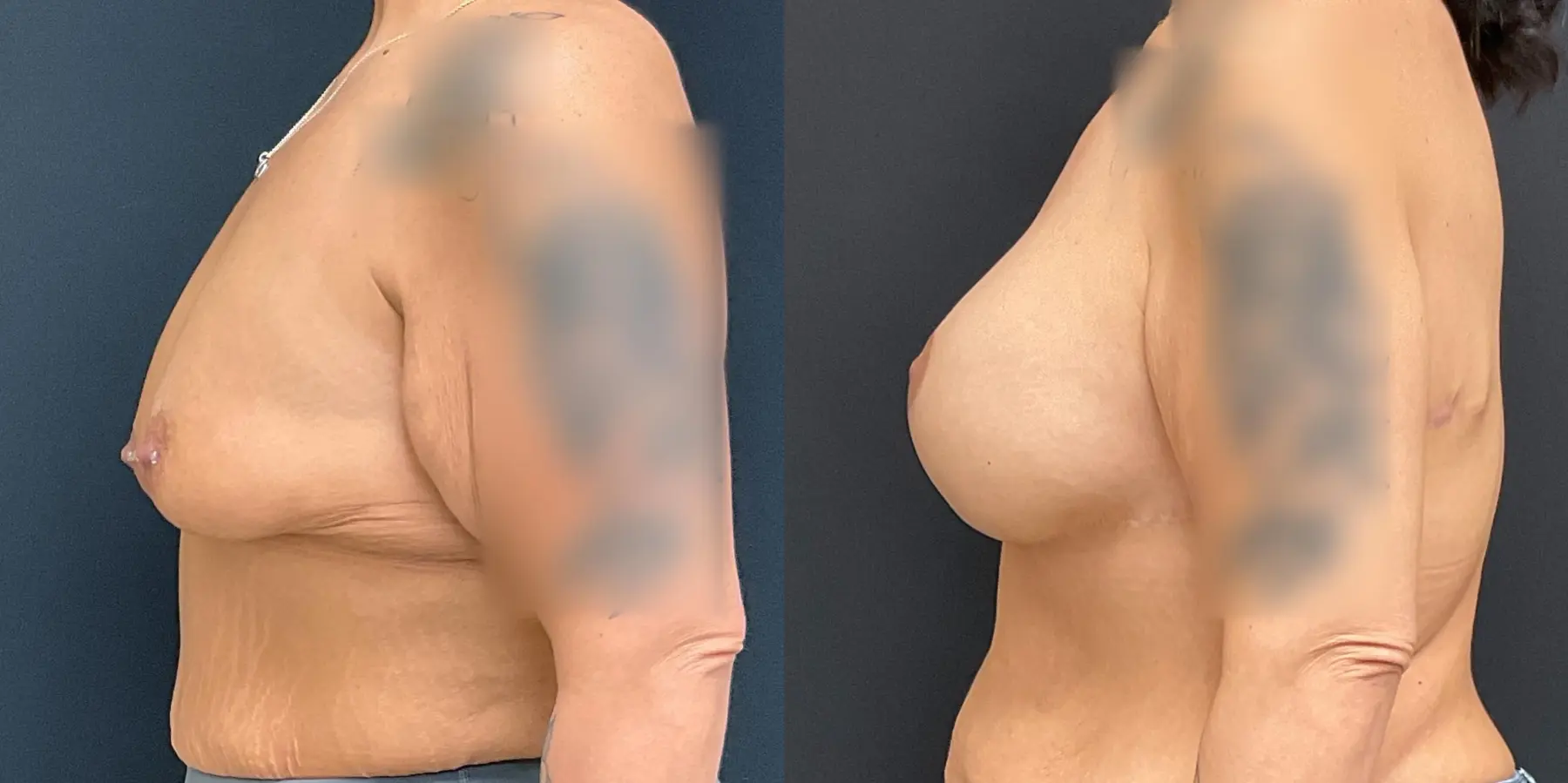 Breast Lift: Patient 8 - Before and After 4
