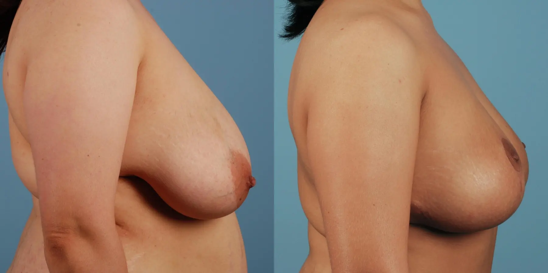 Breast Reduction: Patient 7 - Before and After 2
