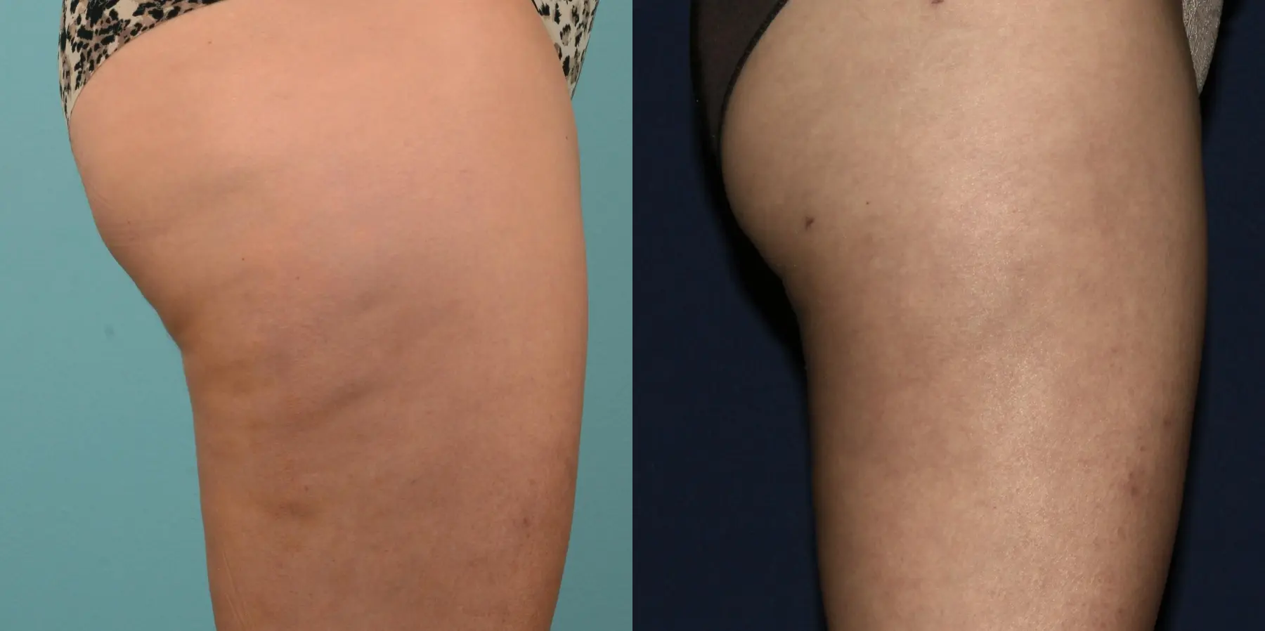 Liposuction: Patient 2 - Before and After 5