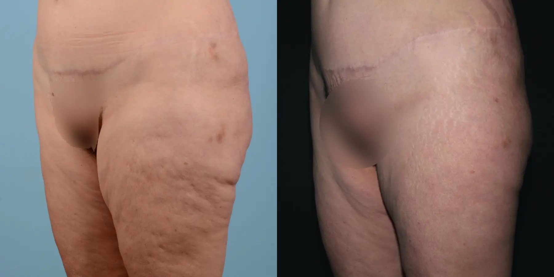 Liposuction: Patient 16 - Before and After 2
