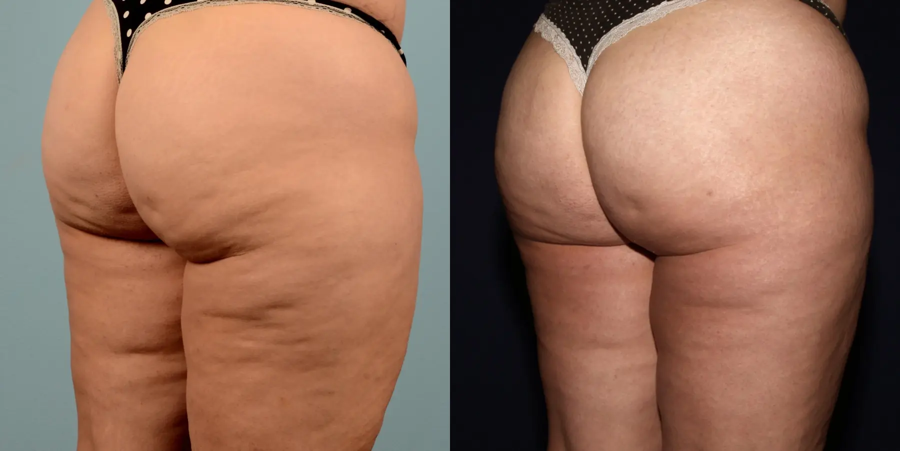 Liposuction: Patient 10 - Before and After 2