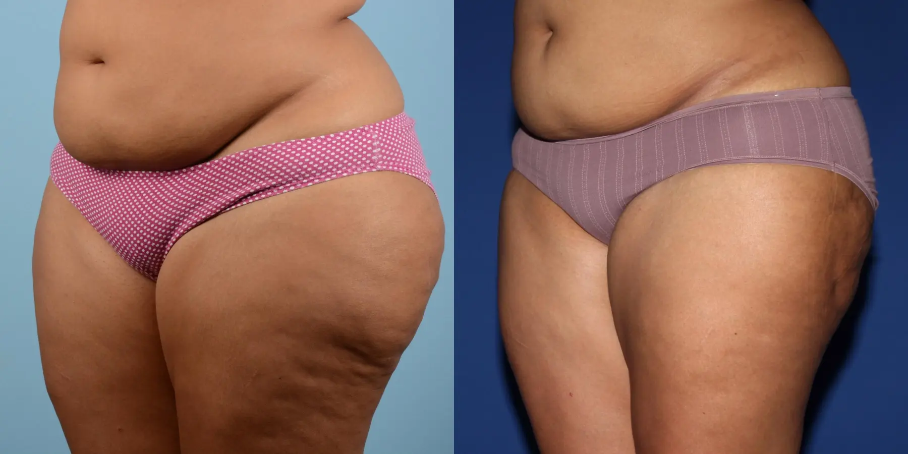 Liposuction: Patient 17 - Before and After 2