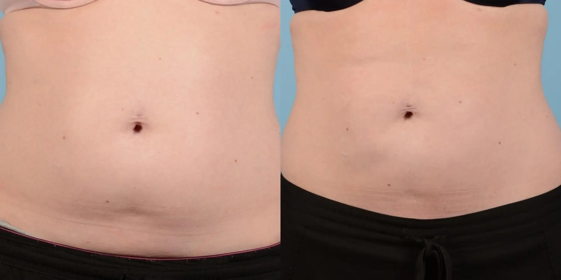 Liposuction: Patient 7 - Before and After  