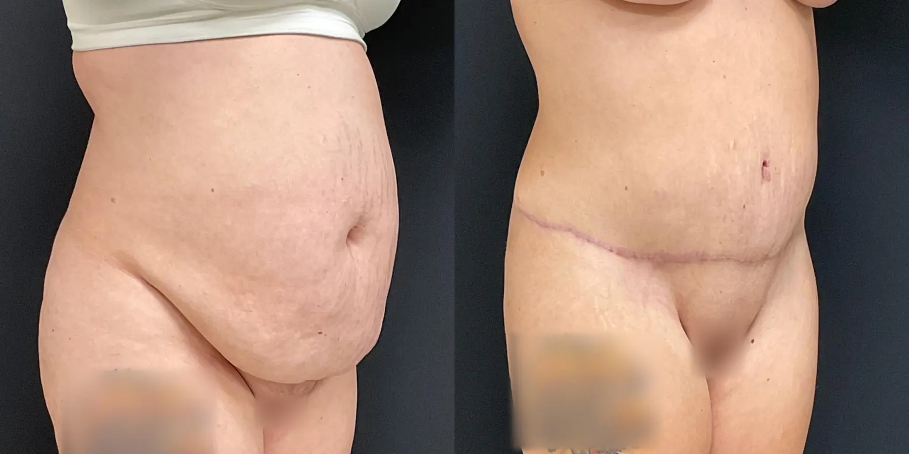 Liposuction: Patient 5 - Before and After 3
