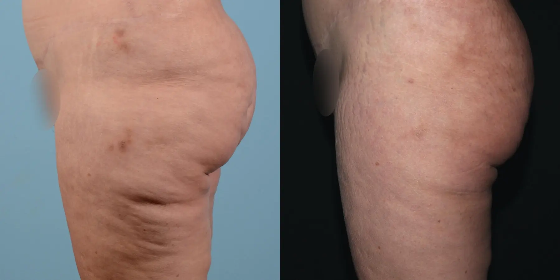 Liposuction: Patient 16 - Before and After 3