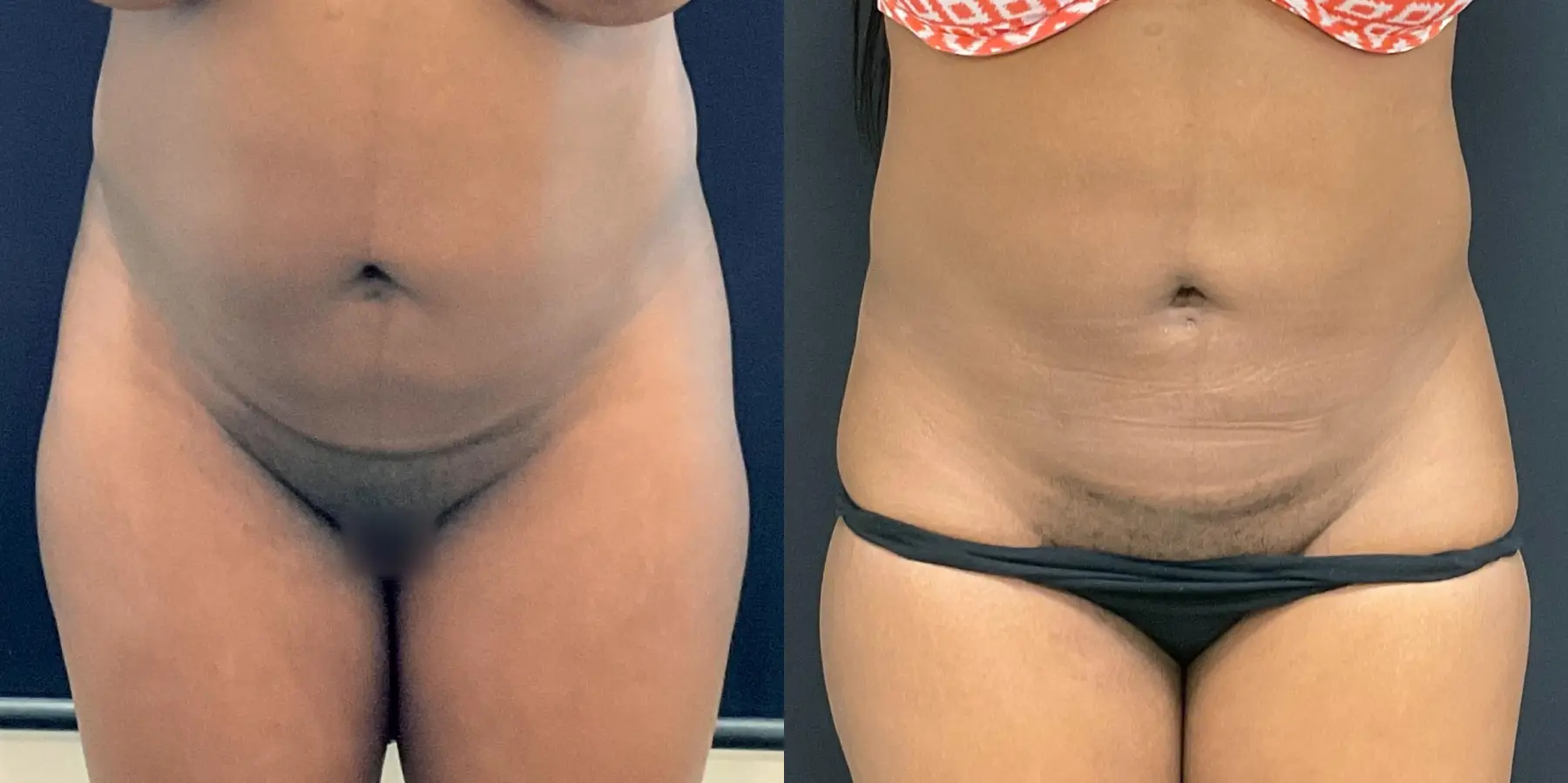 Liposuction: Patient 6 - Before and After  