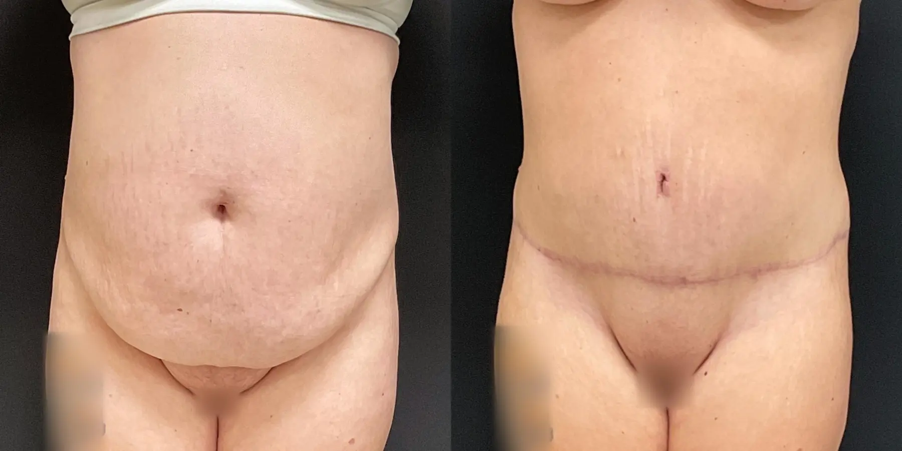 Liposuction: Patient 5 - Before and After  