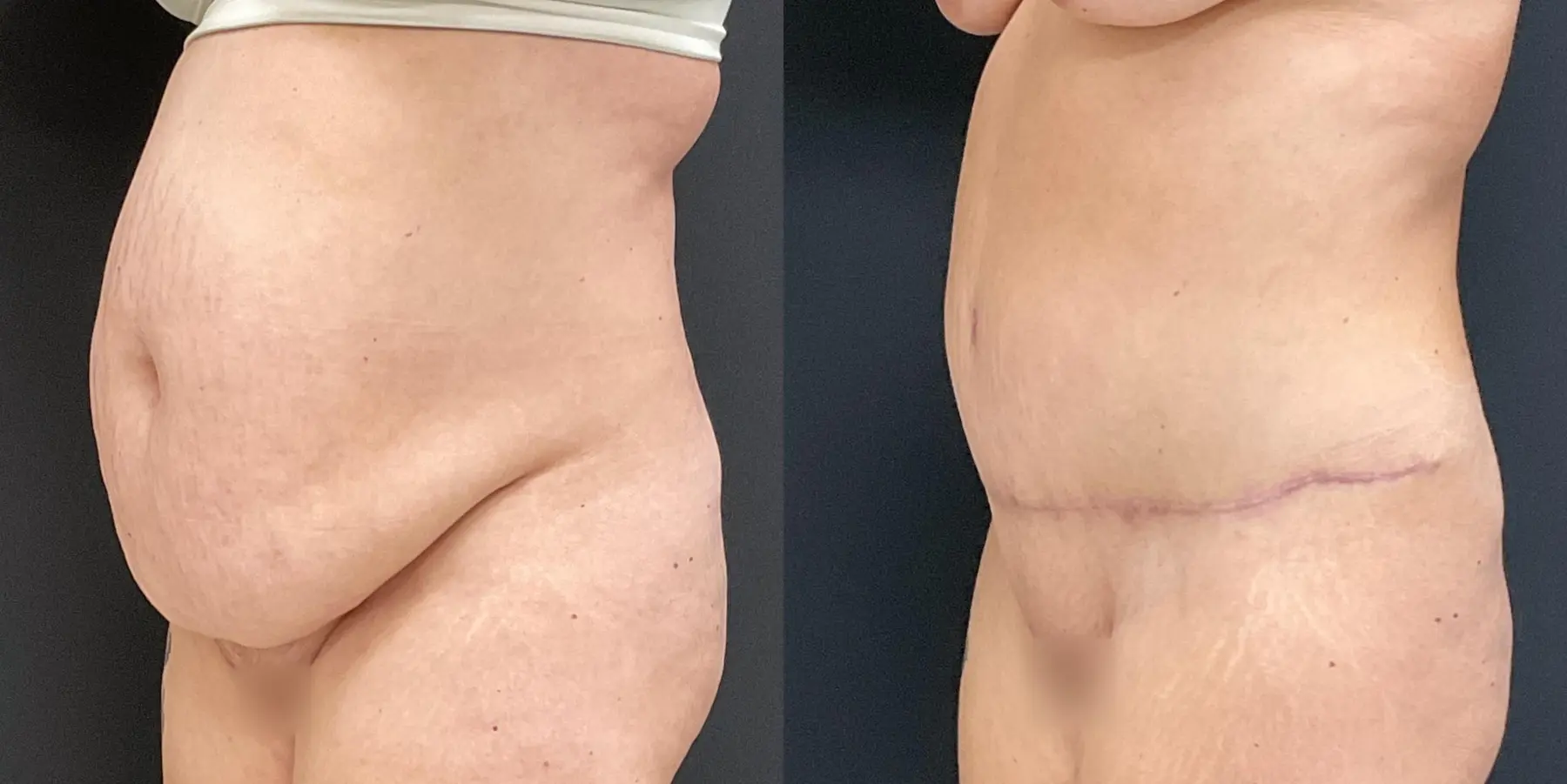 Liposuction: Patient 5 - Before and After 2