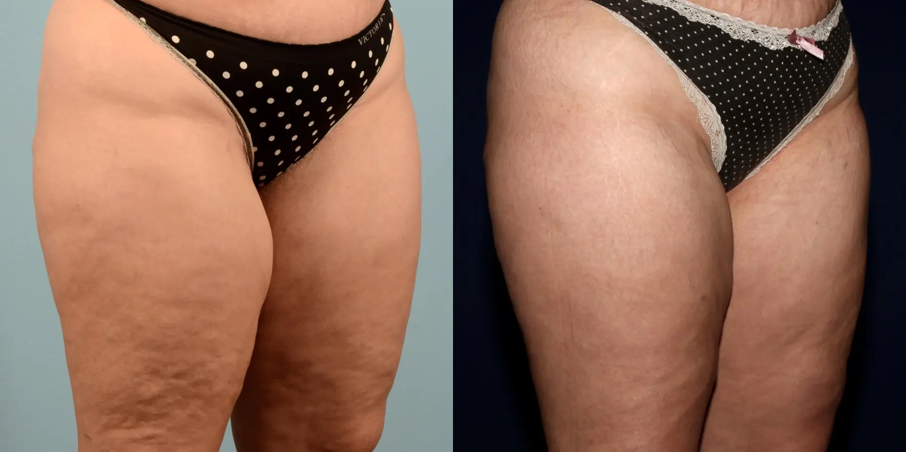 Liposuction: Patient 10 - Before and After 6