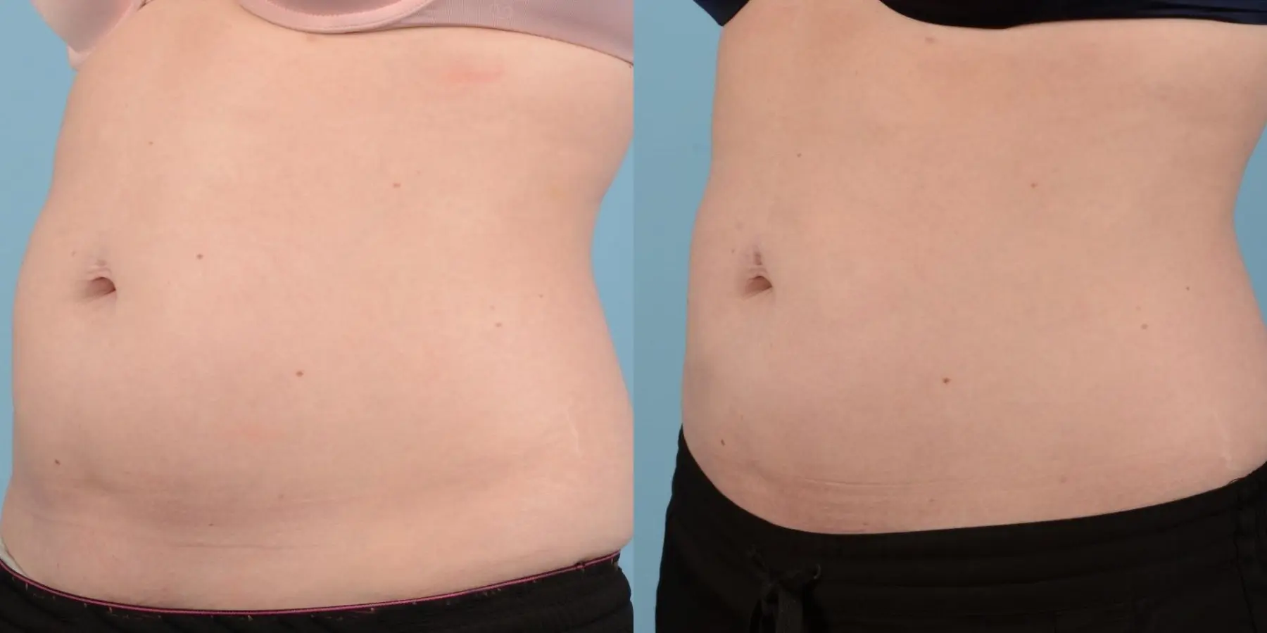 Liposuction: Patient 7 - Before and After 2