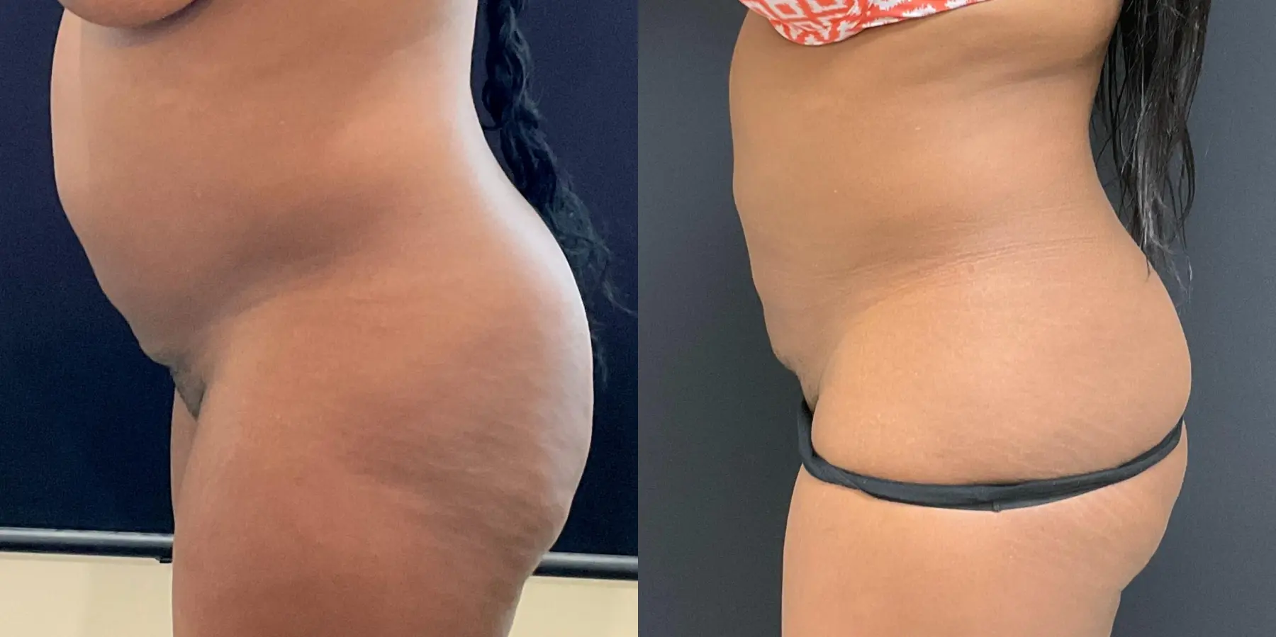 Liposuction: Patient 6 - Before and After 4