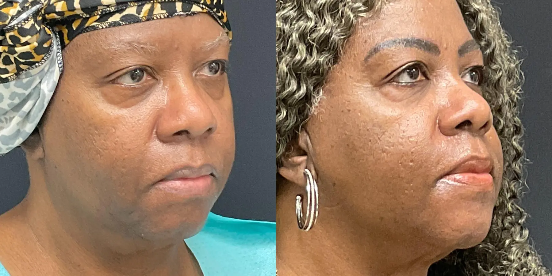 Liposuction: Patient 4 - Before and After 2