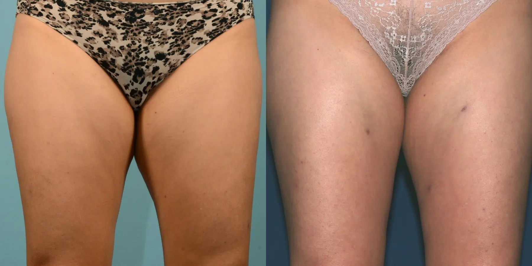 Liposuction: Patient 2 - Before and After  