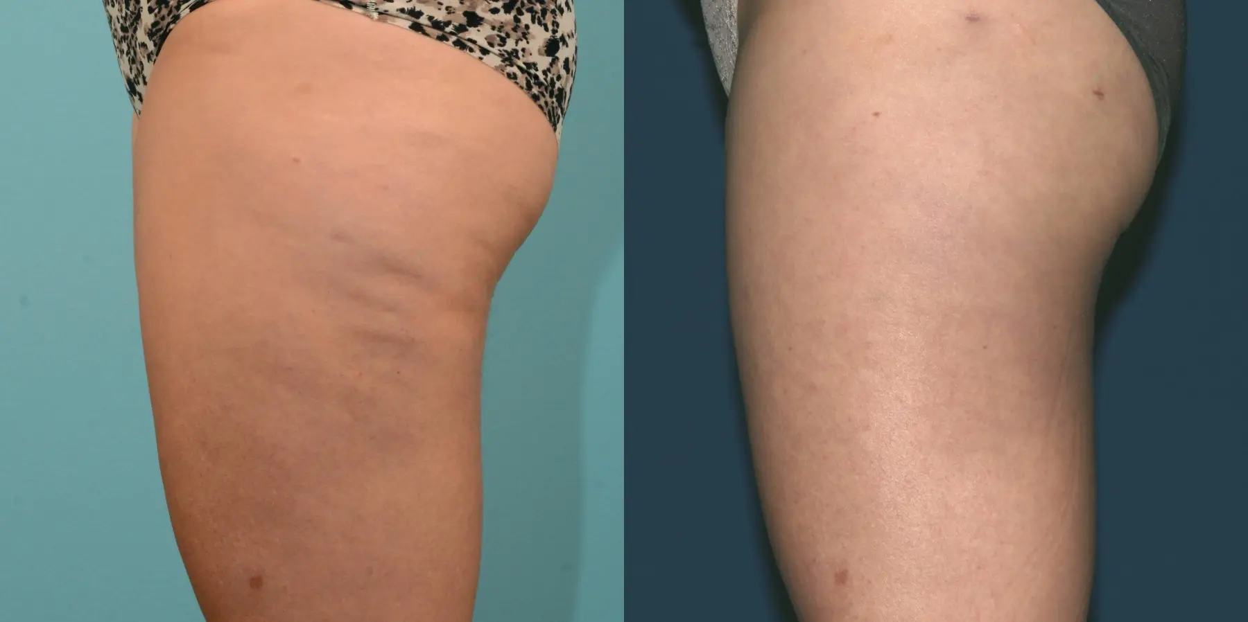 Liposuction: Patient 2 - Before and After 4