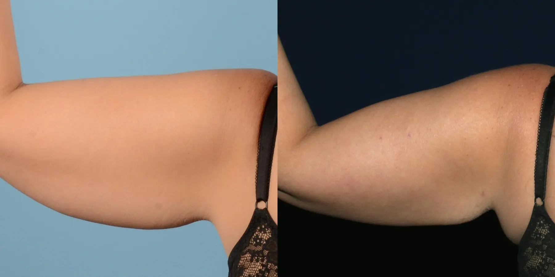 Liposuction: Patient 10 - Before and After 7