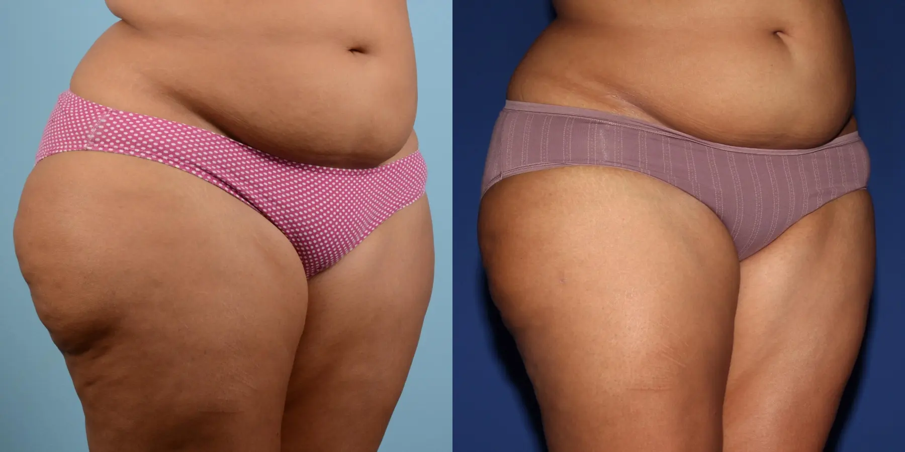 Liposuction: Patient 17 - Before and After 3