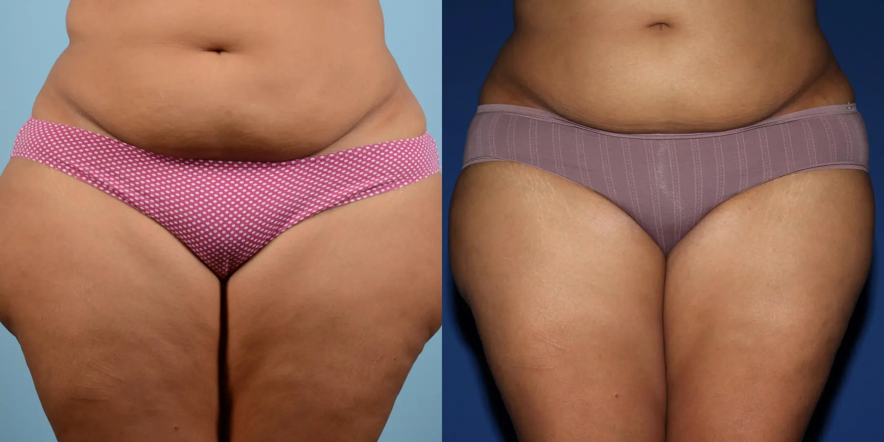 Liposuction: Patient 9 - Before and After  