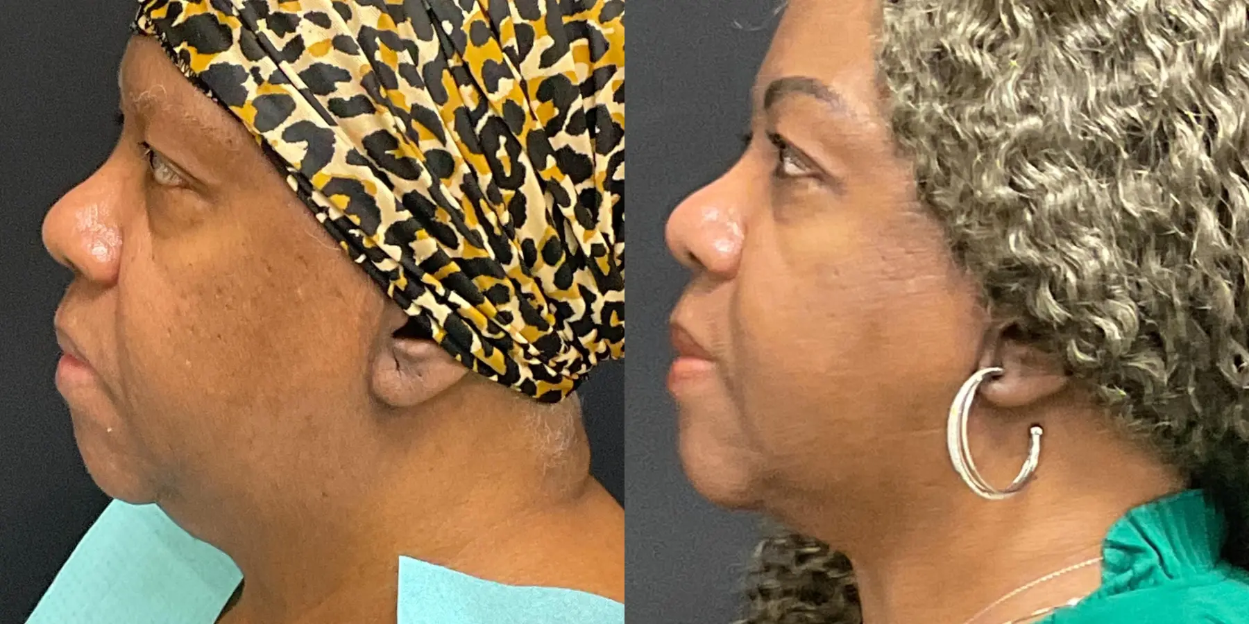 Liposuction: Patient 4 - Before and After 5