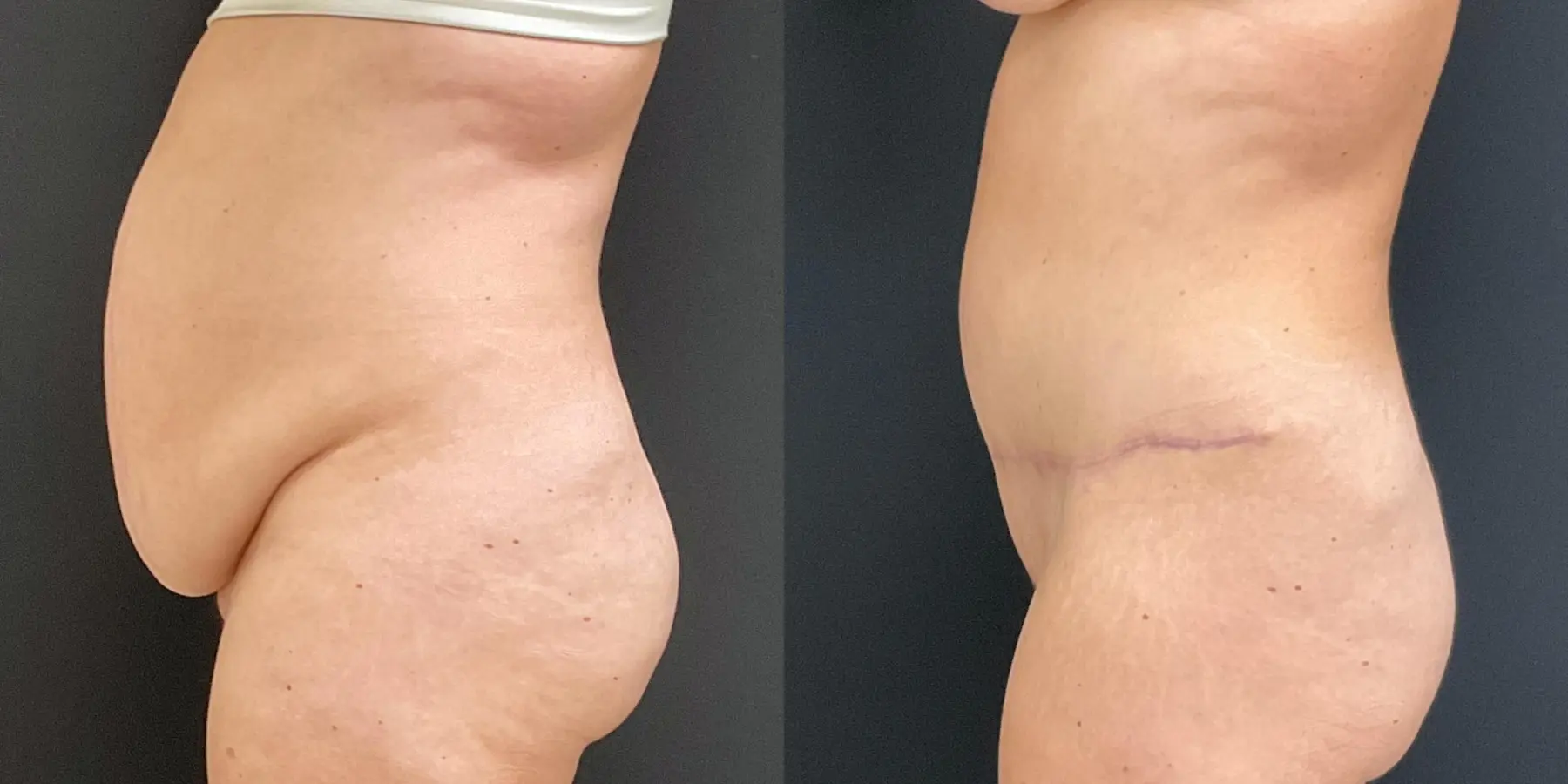 Liposuction: Patient 5 - Before and After 4