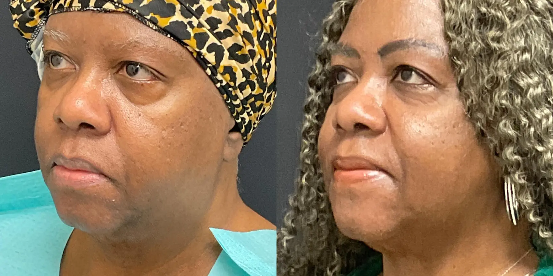 Liposuction: Patient 4 - Before and After 4