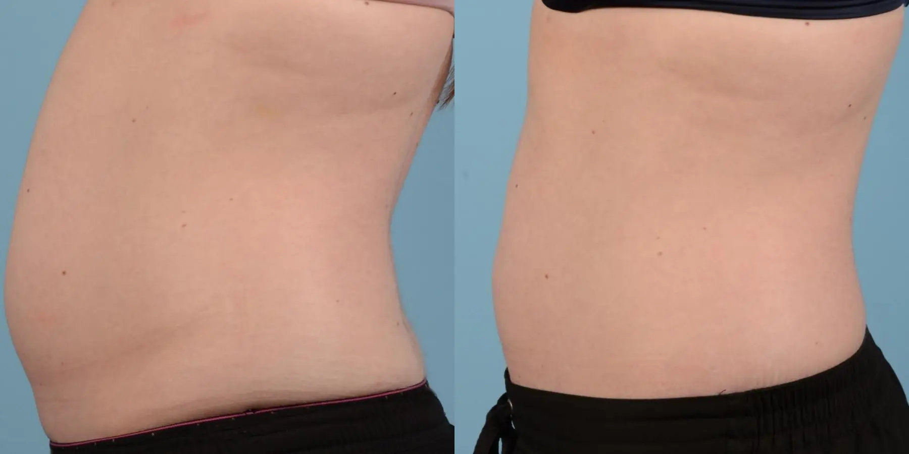 Liposuction: Patient 7 - Before and After 4