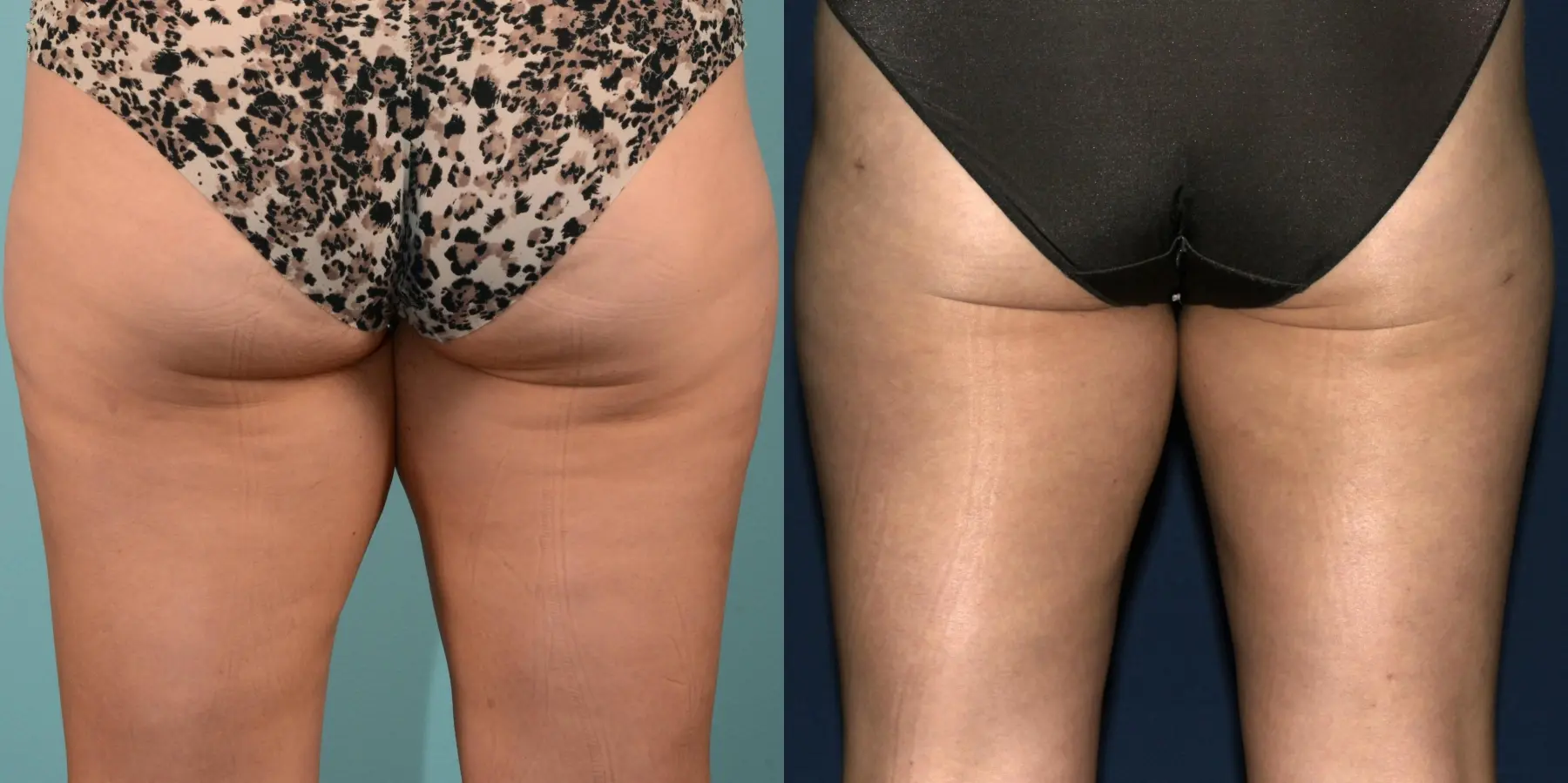 Liposuction: Patient 2 - Before and After 6