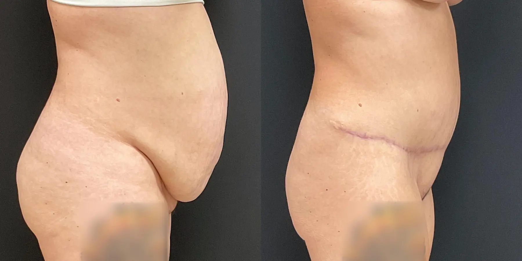 Liposuction: Patient 5 - Before and After 5