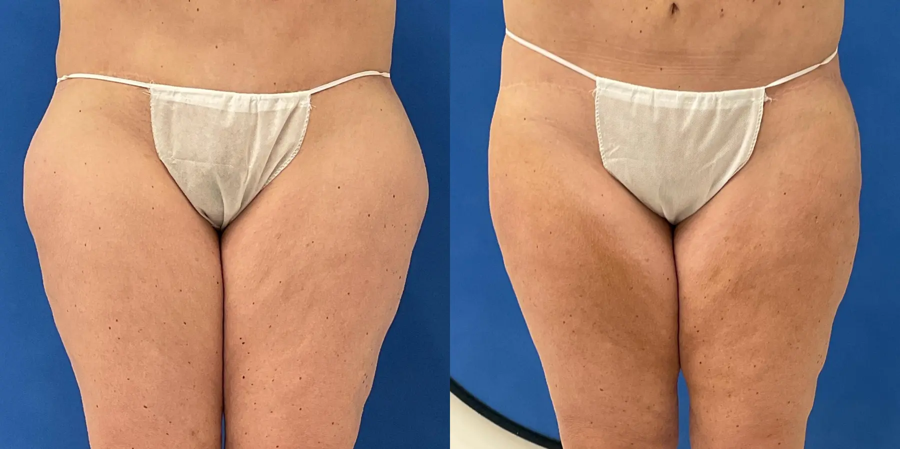 Before and after a liposuction. - Before and After