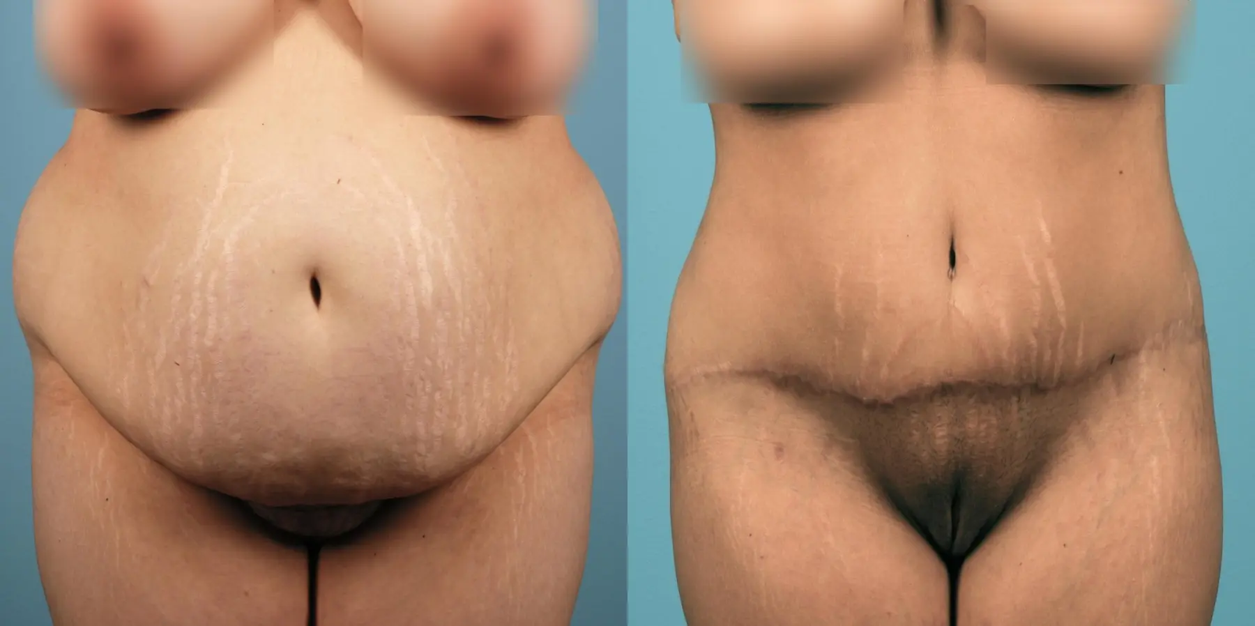 Liposuction: Patient 1 - Before and After  