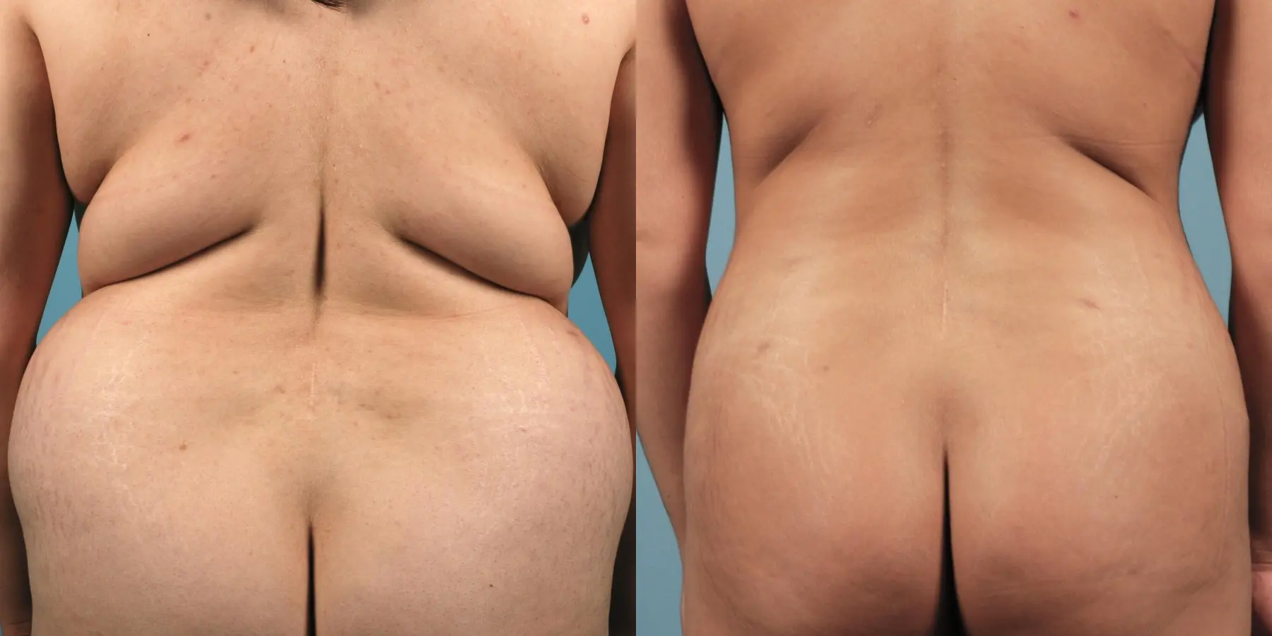 Liposuction: Patient 1 - Before and After 4