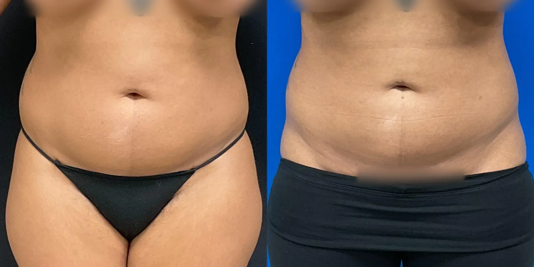 Liposuction: Patient 3 - Before and After  