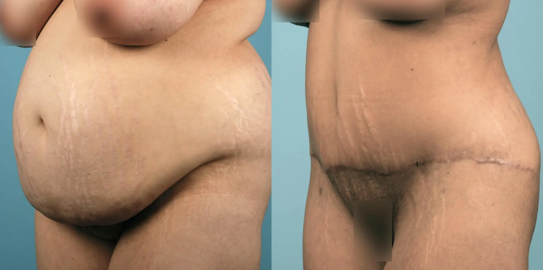 Liposuction: Patient 1 - Before and After 2