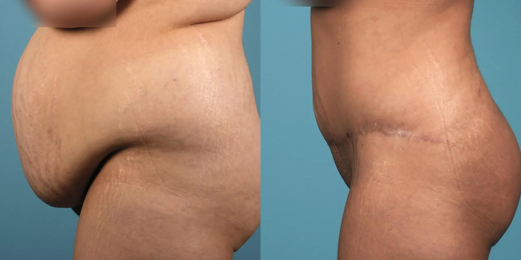 Liposuction: Patient 1 - Before and After 3