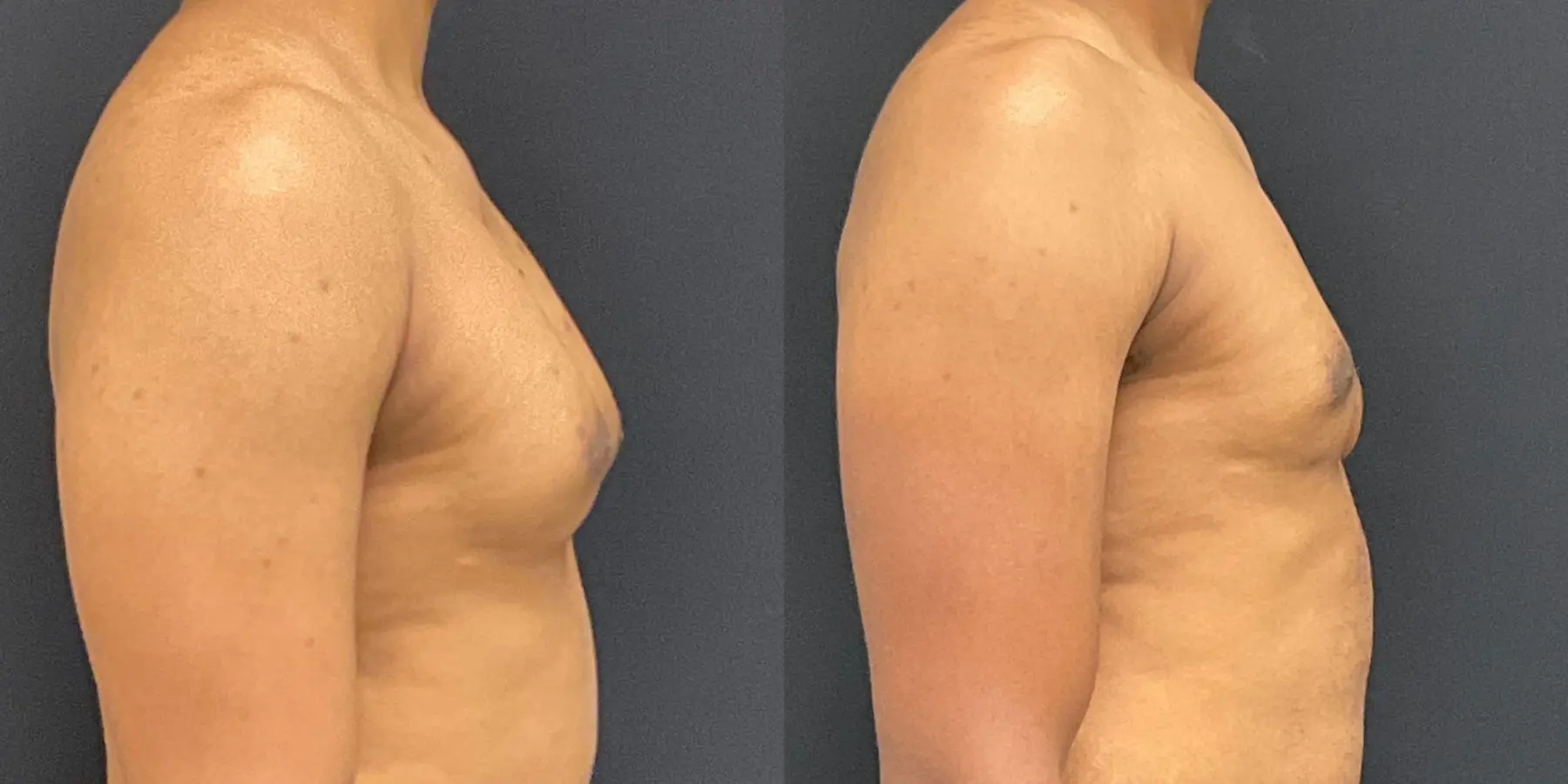 Male Breast Reduction: Patient 8 - Before and After 5