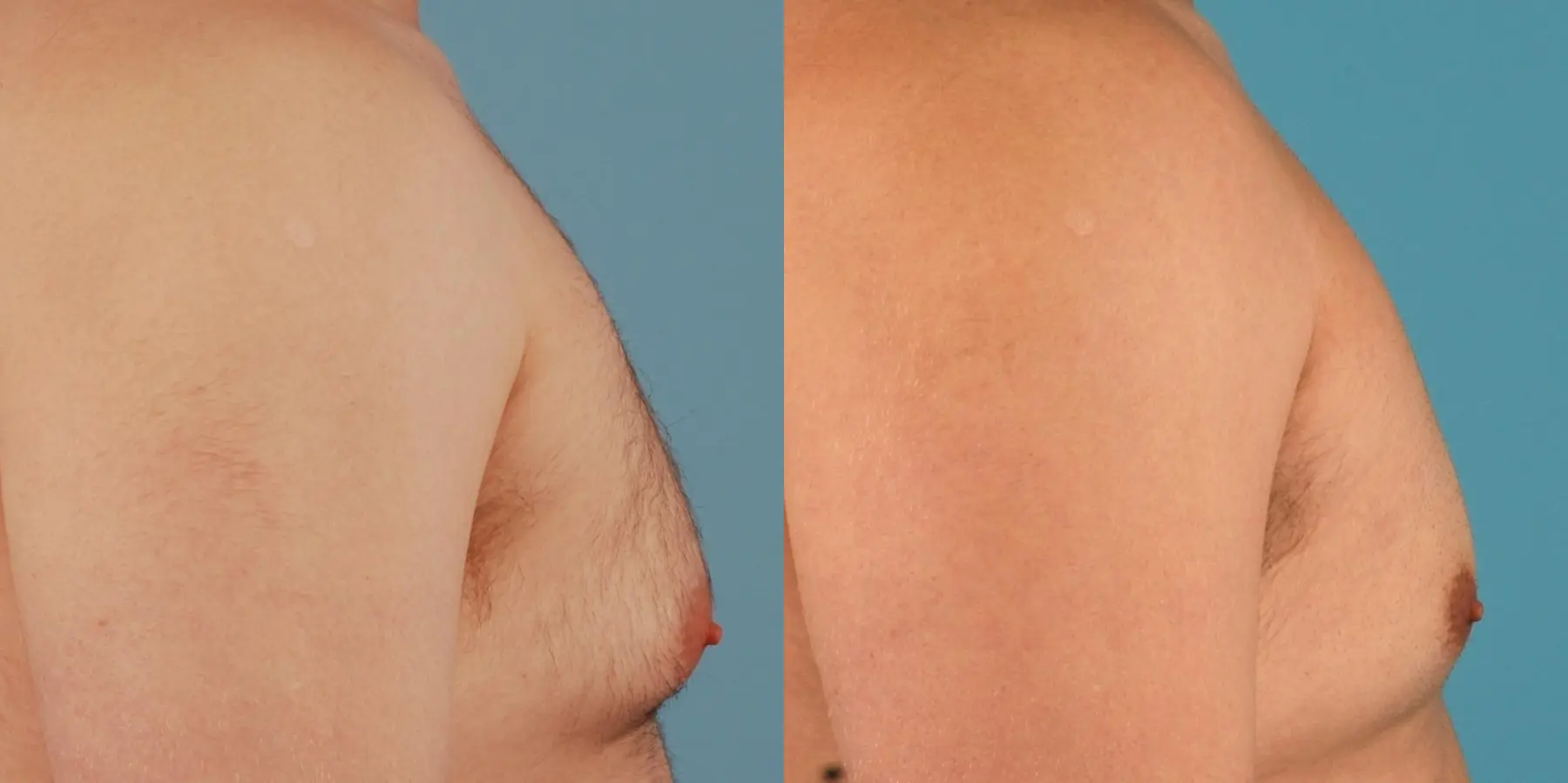 Male Breast Reduction: Patient 12 - Before and After 5