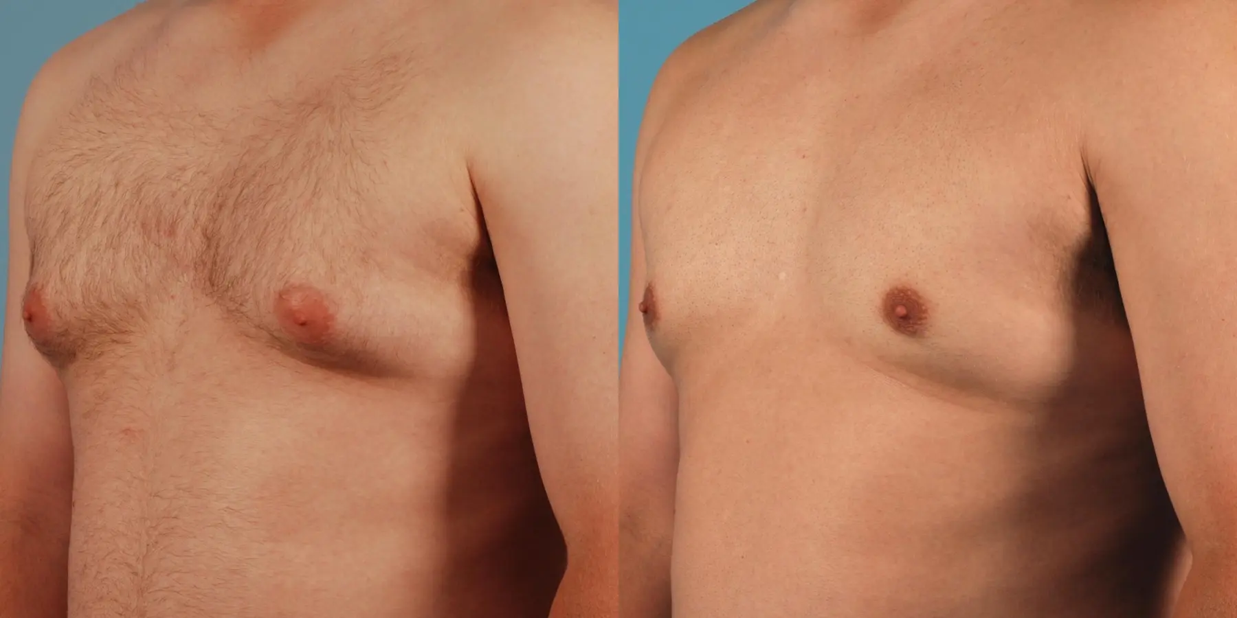 Male Breast Reduction: Patient 12 - Before and After 2