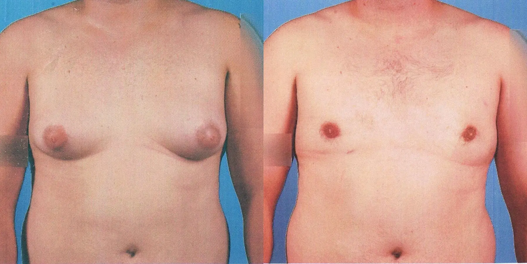 Male Breast Reduction: Patient 10 - Before and After  